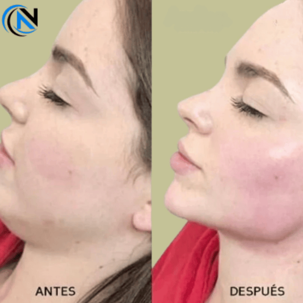 Rejuvenair Skin - Masajeador Facial Antiedad - NavaroExpress🇨🇴